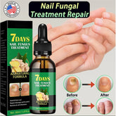 🔥💅Refuse nail rot, ginger nail treatment👣
