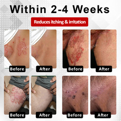 Fivfivgo® Men's HPV Warts Care Spray