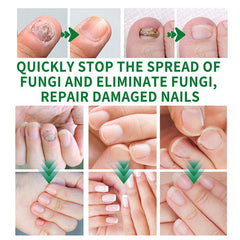 💅Refuse nail rot, ginger nail treatment👣