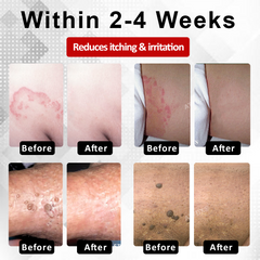 Fivfivgo® Men's HPV Warts Care Spray