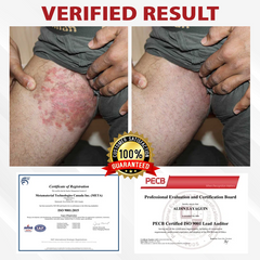 Fivfivgo® Men's HPV Warts Care Spray